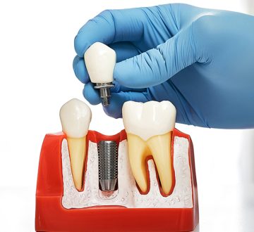 What Are the Upsides of Choosing Dental Implants