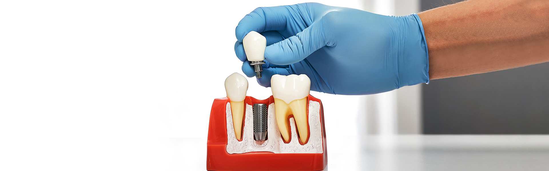 What Are the Upsides of Choosing Dental Implants?